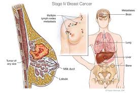 Normal lymph nodes are tiny and can be hard to find, but when there's infection, inflammation, or cancer, the for instance, when breast cancer spreads to the lymph nodes, the cells in the nodes look like breast cancer cells. Why Breast Cancer Emabal Hospitals Limited