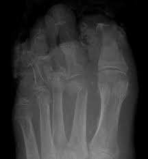 Image result for Osteomyelitis XRay