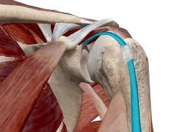 Omaha biceps tendon tear information by dr. Biceps Tendinitis Michael Fu Md Hss Shoulder Surgery