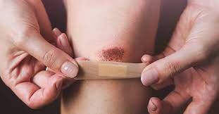 6 Natural Ways To Care For Abrasions At Home - Dr. Axe
