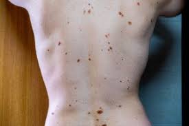 If you aren't sure which type of skin cancer. What Does Precancerous Or Atypical Mole Mean Scary Symptoms
