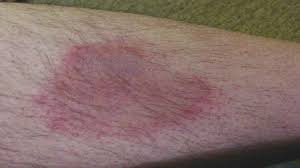 Wie entferne ich die zecke richtig? Borreliose Durch Zecken Tipps Vom Arzt Youtube
