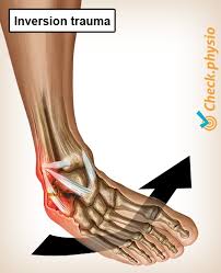 You have a partial tear in the ligament. Lateral Ankle Ligament Injury Physio Check