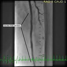 Above the Knee Peripheral Artery Intervention