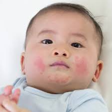 Wondering about seborrheic dermatitis? What is it? How is it treated? Noel  Prevost PA-C breaks down the condition in Pitt Derm's Skin Minute....