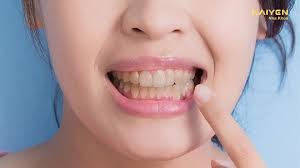 Chân răng bị vàng: Nguyên nhân và cách điều trị hiệu quả – Nha khoa Quốc Tế  KAIYEN