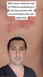 Nurse Jackie Irish Leg Rash