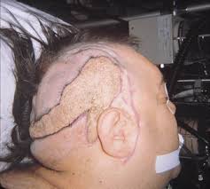 Definition circumscribed lesion that occurs mainly on the face and scalp and consists predominantly of sebaceous glands, abortive hair follicles and ectopic apocrine glands. Segmental Neurofibromatosis In Association With Nevus Sebaceus Of Jadassohn Journal Of The American Academy Of Dermatology