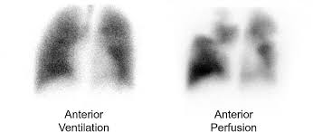 Image result for Ventilation Perfusion Scan