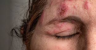 Image result for herpes zoster