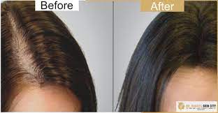 Hair loss had spread to approximately 90% of the scalp 4 months later (figure 1 (b)). Dr Rachi S Skin City Alopecia Hair Fall Treatment Dr Rachi S Alopecia Skin Treatment Alopecia Treatment Center In Vadodara Alkapuri Alopecia Treatment Center In Vadodara Alopecia Skin Treatment Provider Doctor