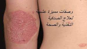 التغذية والصحة طريقة علاج الصدفية بالاعشاب الطبيعية psoriasis herbal treatment herbal treatment herbalism