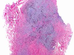 Image result for Blue Nevus