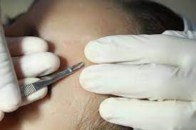 Ekelig distgusting video pop a pimple ekeliges video pickel ausdruecken. Ekel Video 20 Jahre Alter Pickel Wird Endlich Ausgedruckt Brigitte De