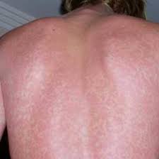 If you are affected with mononucleosis then you should ensure that it does not spread to others. Orthobullets Clinical Photo Shows A Petechial Rash Which Can Be Seen In Infectious Mononucleosis Amoxicillin Increases The Risk Of Rash Facebook