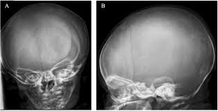 Image result for Craniotabes