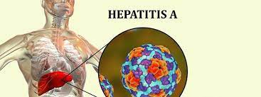 Hepatitis a, also called hep a, is a contagious liver infection caused by the hepatitis a virus. Haufig Gestellte Fragen Zu Hepatitis A Haufig Gestellte Fragen Hepatitis
