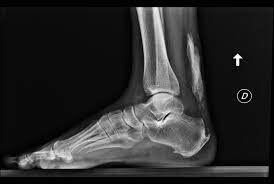 Achilles Tendon Ossification Radiology Case Radiopaedia Org