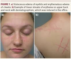 Image result for Dermatographism