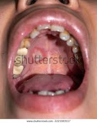 Image result for Physical injury red spots roof of mouth