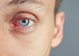 Image result for Dry Eye