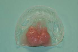 Maybe you would like to learn more about one of these? The Clinical Histologic And Treatment Spectrum In Necrotizing Sialometaplasia Oral Surgery Oral Medicine Oral Pathology And Oral Radiology