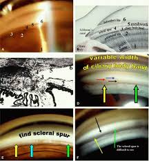 Image result for Gonioscopy