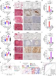 Lung cancer is most often discovered by mistake if it is detected in the early stages. Lung Gene Expression Signatures Suggest Pathogenic Links And Molecular Markers For Pulmonary Tuberculosis Adenocarcinoma And Sarcoidosis Communications Biology