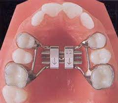 Bracesonmain Dr Samuel Chiang Dr Daniel Cheng Orthodontist Orthodontics Orthodontist Teeth Expander