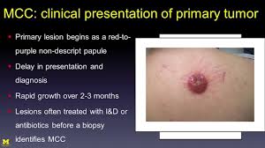 Image result for Merkel Cell Carcinoma