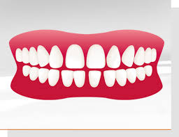 Die Haufigsten Zahnfehlstellungen Uberbiss Kreuzbiss Tiefbiss Kieferorthopadische Praxis Dr Med Dent Peter Borg