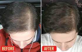Whatever the cause of hair loss is, emu oil is a remedy that revives your hair growth in as short as 3 months. Emu Oil For Hair Growth How To Use Benefits Reviews