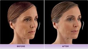 Voluma • Osman Dermatology