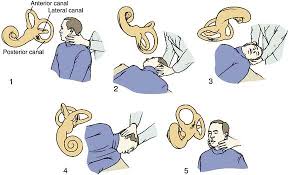 Image result for Canalith Repositioning Procedure