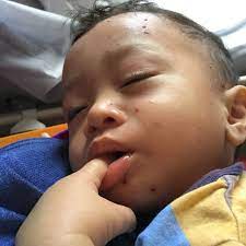 Menurut kementerian kesihatan malaysia (kkm), chicken pox ialah jangkitan biasa yang paling penting, jaga pemakanan pesakit, kuarantin mereka agar tidak merebak dan jaga kebersihan diri. Ily S Fathan Chicken Pox Dan Cuti Kuarantin