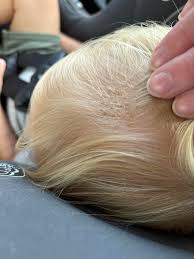 Image result for Cradle Cap