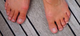 Image result for Hammer toe