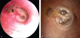 Diagnosis Of Ear Pain American Family Physician