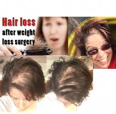 Pin On Hair Loss Help