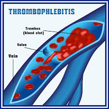 The Truth About Blood Clots Warning Signs Symptoms