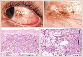 Image result for melanosis sclera