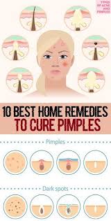 10 Simple Home Remedies For Pimples How To Cure Pimples Home Remedies For Pimples Home Remedies For Acne
