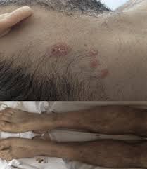 Retención de líquidos con hinchazón de las piernas, los tobillos y los pies. Archives Miocardite Abc Cardiol