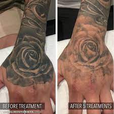 Getting Some Great Results On Jessstrend Hand After Only 5 Treatments Follow Us At Tailoredtattooremoval To Stay Tattoo Removal Tattoo Removal Cream Tattoos