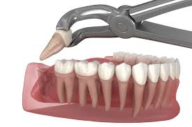 Image result for Tooth Extraction