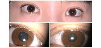 Image result for Mydriasis