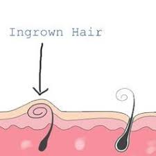 How to deal with an ingrown pubic hair while a lot of ingrown hairs will resolve on their own, some might need a little intervention. How To Remove An Ingrown Hair On Your Bikini Line Ingrown Hair Ingrown Hair Removal Bikini Line Ingrown Hair
