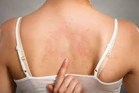 Maybe you would like to learn more about one of these? Hep C Symptoms Could Your Rash Be One Hepatitis Central