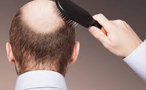 تجارب زراعة الشعر في مصر مع الأسعار موسوعة