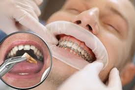 Image result for Tooth Extraction